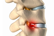 Как вылечить межпозвоночную грыжу без операции