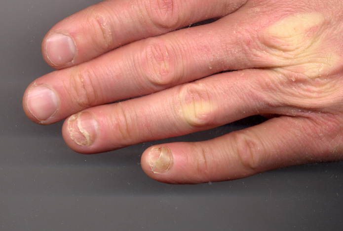 Раскрыты способы определить заболевание по внешнему виду ногтей