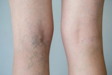 Этот продукт вызывает тромбоз. Должны знать все