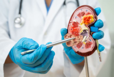 Назван анализ, который может случайно выявить рак почки