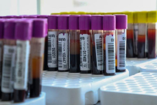 Врач назвала два вещества в крови человека, способных разрушить почки