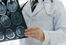 Ученые обнаружили, что у пациентов с инсультом сосуды забиты микропластиком