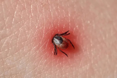 Инструкция, которая может спасти жизнь. Как проверить себя и близких на клеща