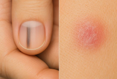 Рак кожи можно распознать по этим двух признакам