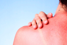 Быстрая помощь ожогам без аптек — простое средство из вашего холодильника