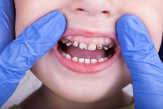 Названо время, за которое на зубах образуется пленка из бактерий