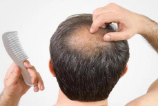 Врач рассказала, какие анализы стоит сдать при выпадении волос