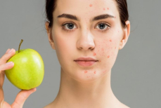 Нужно ли людям с акне соблюдать какую-либо диету — отвечает врач