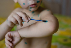 Всплеск ветрянки у детей — как вовремя заметить симптомы и помочь ребенку