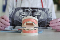 Как безопасно заниматься спортом с брекетами