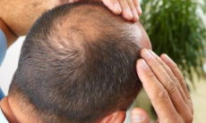 Учёные нашли способ избавиться от лысины без операций за 20 дней