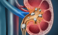 Почему у змей не появляются камни в почках