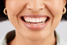 «Разъедает ослабленную эмаль». Это популярное народное средство для отбеливания разрушает зубы