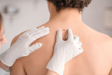 Онколог объяснила, как распознать опасную родинку