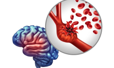 Что такое аневризма и как она появляется