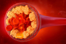 Назван фрукт, снижающий уровень холестерина в крови