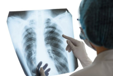 17-летнему курильщику удалили легкое и вручили его в пакете