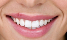 Как быстро убрать герпес на губах