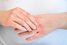 Как защитить кожу в мороз