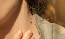 Какие папилломы могут перерасти в рак