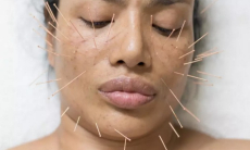 Какие боли может эффективно снять иглоукалывание