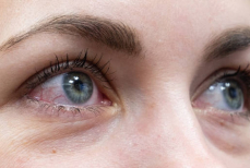 Эксперт рассказала, как помочь покрасневшим глазам после слез