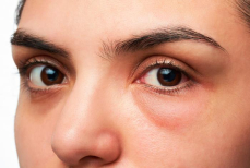 Как отличить почечные отеки — объяснение врача