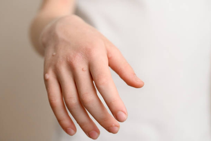 Названа главная опасность «неприличных» бородавок